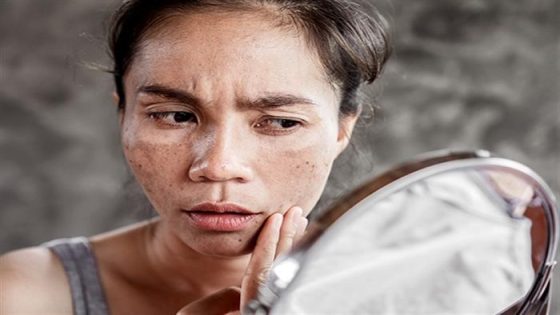 علامات ارتفاع نسبة الكوليسترول تظهر على الوجه لا يجب أن تتجاهلها أبدًا